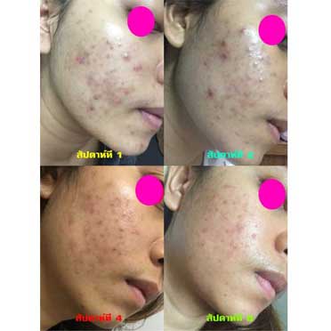 dermaklear 6 week